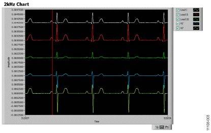 Screen shot of the ADAS1000 connected to the patient simulator, heart rate = 70 BPM