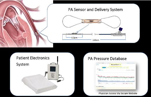CardioMEMS心衰监测传感器有效降低住院率