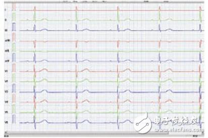 采用MSP430FG4616单片机与模数转换器实现心电图机系统的设计