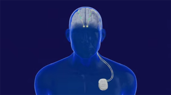 广西成功开展首例脑机接口手术:帕金森患者将实现生活自理!