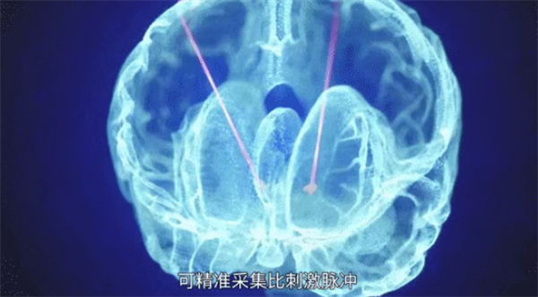 广西成功开展首例脑机接口手术:帕金森患者将实现生活自理!