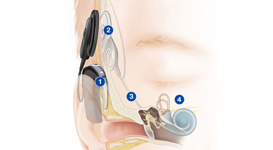 ICsense为Cochlear开发人工耳蜗ASIC